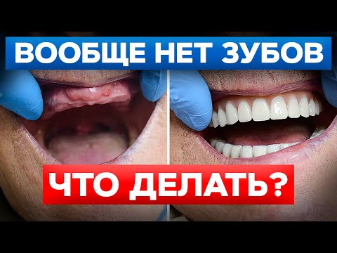 Видео: Что делать, если не осталось ни одного зуба во рту? / Импланты на все зубы