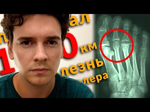 Видео: Пробежал 1000 км с больной ногой. Диагноз - болезнь Келлера. Марафон вокруг света.