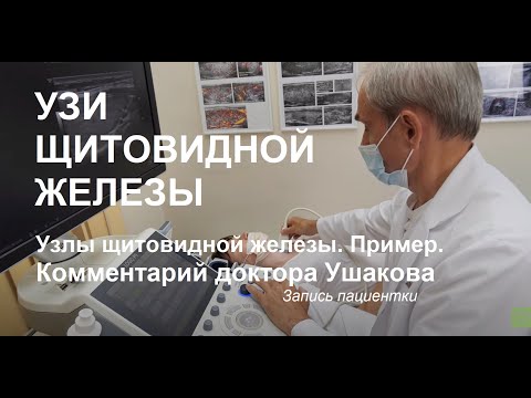 Видео: УЗИ щитовидной железы. Узлы щитовидной железы. Пример комментария после УЗИ || Доктор Ушаков