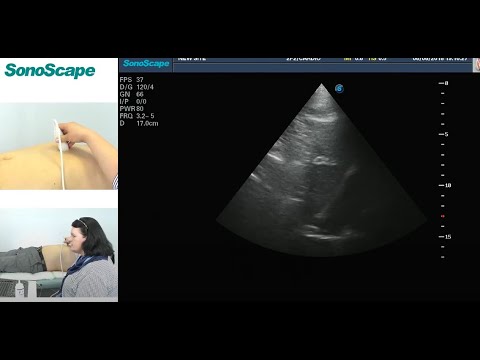 Видео: Мастер-класс на аппарате SonoScape S8Exp. Лектор: Рыбакова М.К.
