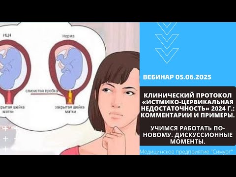 Видео: «Клинический протокол «Истмико-цервикальная недостаточность» 2024 г.» Вебинар 5.06.2025