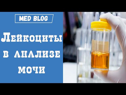 Видео: Лейкоциты в анализе мочи | Причины повышения лейкоцитов в моче | Что это значит? | Норма лейкоцитов