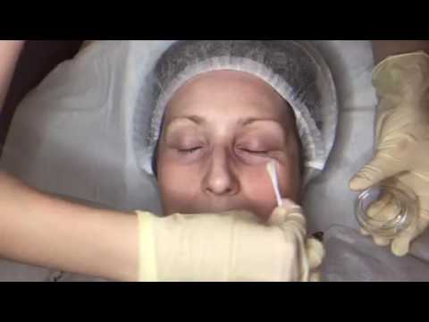 Видео: Химический пилинг - миндальный