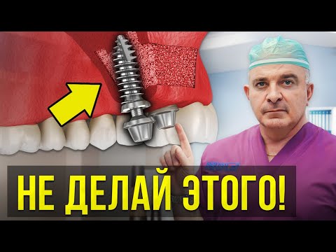 Видео: Не делай ИМПЛАНТАЦИЮ, пока не узнаешь ЭТО! Вся правда о синус-лифтинге