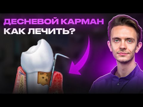 Видео: ЧТО ТАКОЕ ОТКРЫТЫЙ КЮРЕТАЖ? ЛЕЧЕНИЕ ДЕСНЕВОГО КАРМАНА.