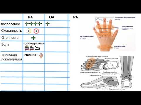 Видео: дифференциальная диагностика артритов