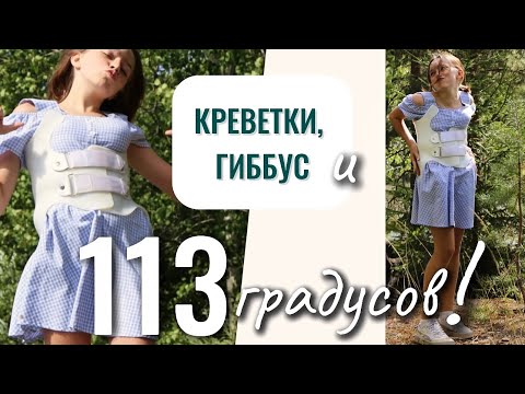 Видео: Креветки, гиббус и 113 градусов сколиоза