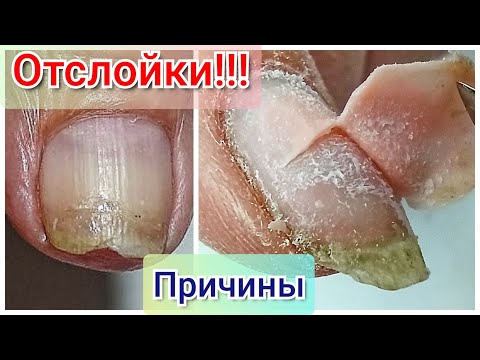 Видео: Отслойки, Причины Возникновения, Подготовка Ногтевой Пластины, Выбор Материалов для Маникюра