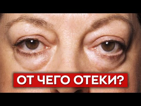 Видео: Как убрать отеки с помощью питания?