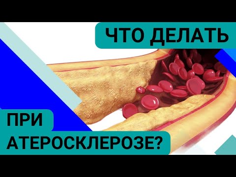 Видео: У МЕНЯ НАШЛИ АТЕРОСКЛЕРОЗ: что делать?