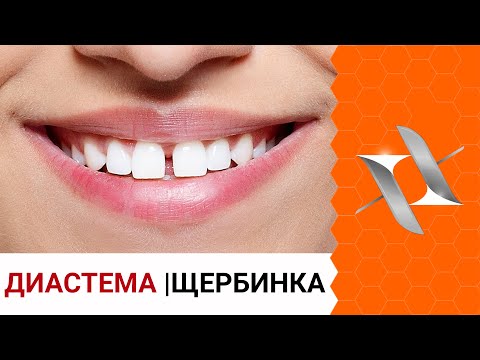 Видео: ДИАСТЕМА/щербинка | Почему возникает, как убрать и можно ли оставить?