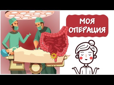 Видео: Как мне вырезали аппендикс 💉 История из больницы. [Анимация]