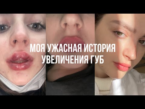 Видео: УВЕЛИЧЕНИЕ ГУБ | мой печальный опыт | как мне испортили губы