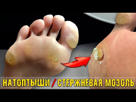 Видео: Педикюр СТОЛОВЫМИ ПРИБОРАМИ?! СТЕРЖНЕВАЯ МОЗОЛЬ 🤯 от ГВОЗДЯ . ГЛУБОКАЯ МОЗОЛЬ. ПЕДИКЮР.MASSIVE CORN