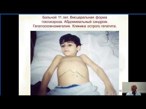 Видео: ГЕЛЬМИНТОЗЫ (эпидемиология и профилактика)