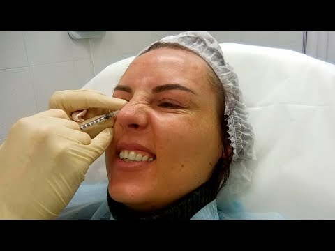 Видео: МОЙ ПЕРВЫЙ БОТОКС. Я СДАЛАСЬ. ДО и ПОСЛЕ.