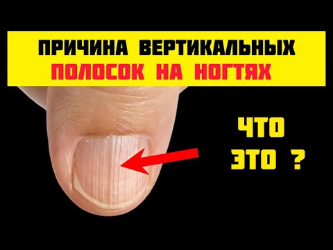 Видео: Вертикальные Борозды на Ногтях – Что Они Значат и Когда Это Опасно