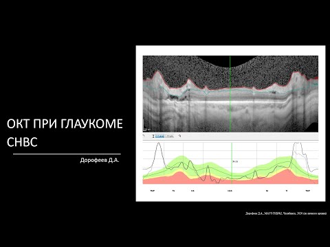 Видео: ОКТ при глаукоме. СНВС. 3/7