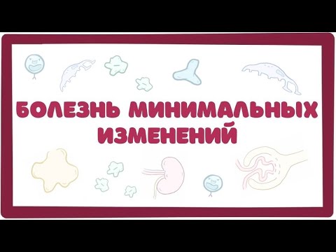 Видео: Болезнь Минимальных Изменений (нефротический синдром) лекция