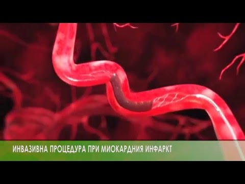 Видео: Д-р Ивайла Желева, Клиника по Кардиология, Токуда Болница: За сърдечния инфаркт