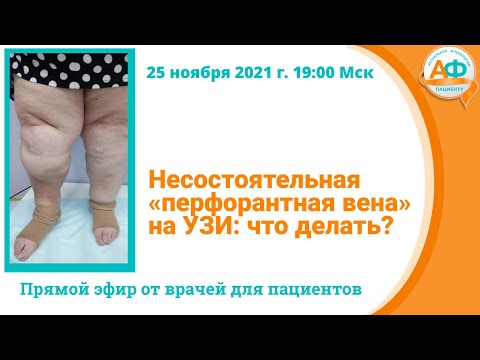 Видео: Несостоятельная перфорантная вена на УЗИ что делать