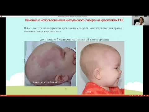 Видео: Мальформация кровеносных сосудов у детей на лице, голове  и шее