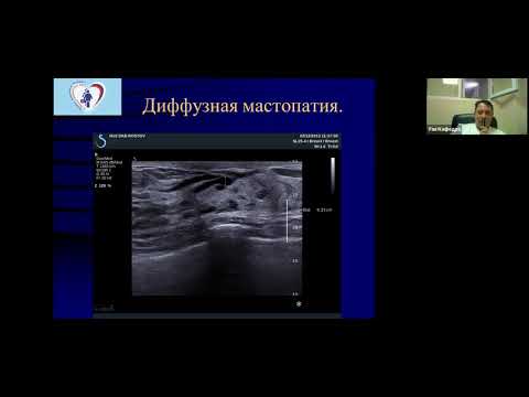 Видео: УЗД Молочных желез ч1 Болоцков А С