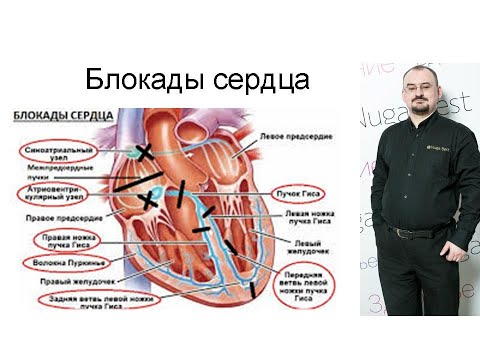 Видео: Блокады сердца. Электрокардиостимулятор.