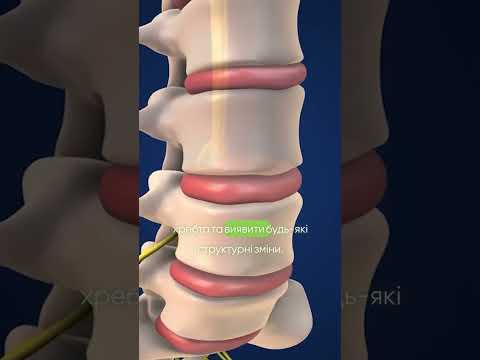 Видео: Діагностика сколіозу