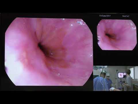 Видео: 03Live Ткаченко ОБ Очаговая метаплазия нижней трети пищевода PENTAX 7010