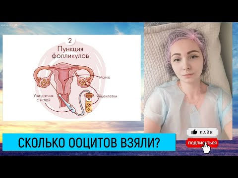 Видео: ПУНКЦИЯ ФОЛЛИКУЛОВ. Мой первый  свежий протокол ЭКО. Видео № 8