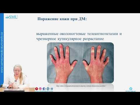 Видео: Дерматомиозит