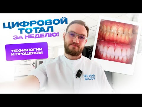 Видео: Цифровой тотал за неделю! Полный рот коронок и виниров. Стас Белоус Стоматолог Ульяновск