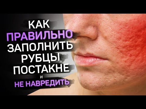 Видео: Заполняем рубцы постакне