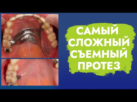 Видео: Нет зубов с одной стороны. Односторонний концевой дефект.