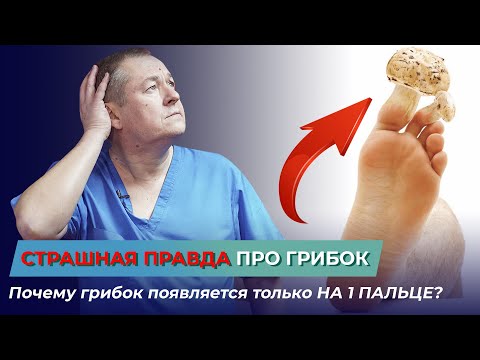 Видео: Страшная правда про ГРИБОК. Почему грибок появляется только на 1 пальце? Грибок на ногтях.