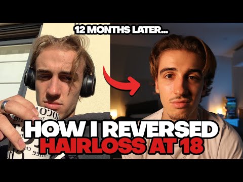 Видео: Как остановить выпадение волос за 12 месяцев (протокол без обмана)