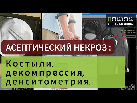 Видео: АСЕПТИЧЕСКИЙ НЕКРОЗ: Костыли, декомпрессия, денситометрия