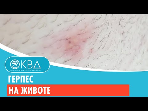 Видео: 😐 Герпес на животе. Клинический случай №398