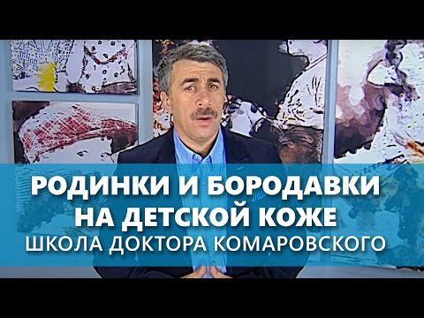 Видео: Родинки и бородавки на детской коже - Школа доктора Комаровского