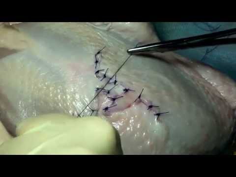Видео: Методика закрытия кожного дефекта по Лимбергу