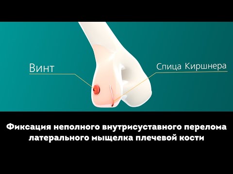 Видео: Фиксация неполного внутрисуставного перелома латерального мыщелка плечевой кости