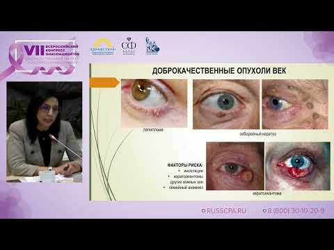 Видео: Амирян А.Г., Бородин Ю.И. | Опухоли век