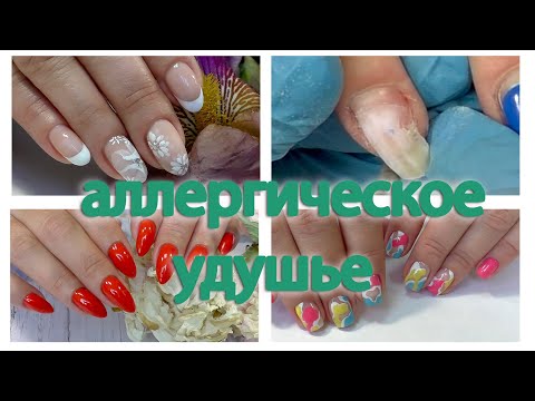 Видео: ОТСЛОЙКИ на ногтях. Хроника. СКОРАЯ помощь, происшествия. Свело руки