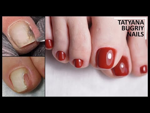 Видео: Аппаратный Педикюр/ Ремонтируем ТРАВМИРОВАННЫЙ ноготь/ Покрытие Гель лаком на ногах