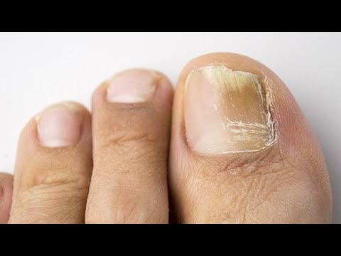 Видео: ЛЕЧЕНИЕ ОНИХОМИКОЗА