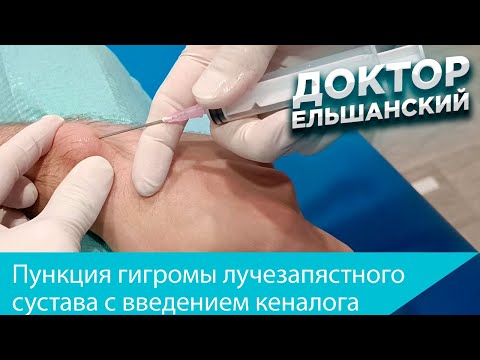 Видео: Пункция гигромы лучезапястного сустава с введением кеналога