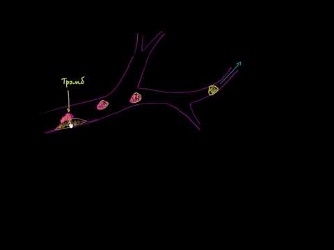 Видео: Тромбоэмболы и тромбоэмболия