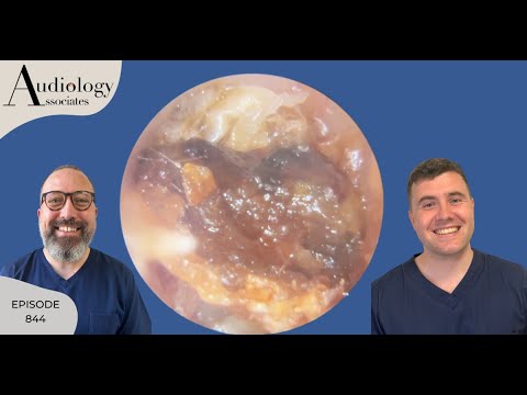 Видео: Удаление стойких толстых кератиновых волос - EP842