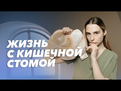 Видео: Что такое кишечная стома? Колостома: уход и осложнения